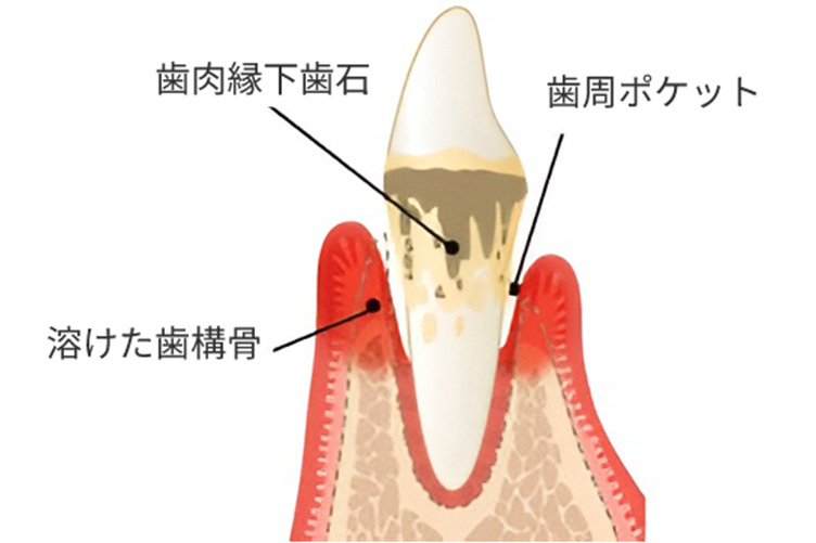 歯周炎