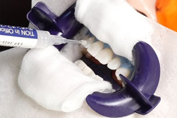 オフィスホワイトニング