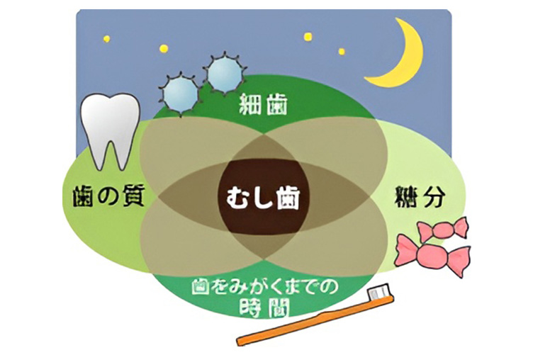 むし歯による4条件
