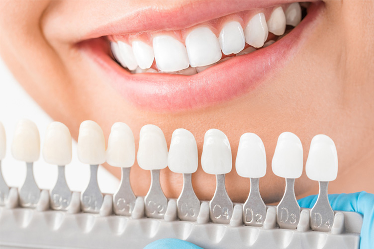 美しさを追求する審美歯科