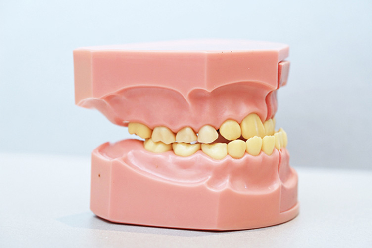 子どもの受け口（反対咬合）