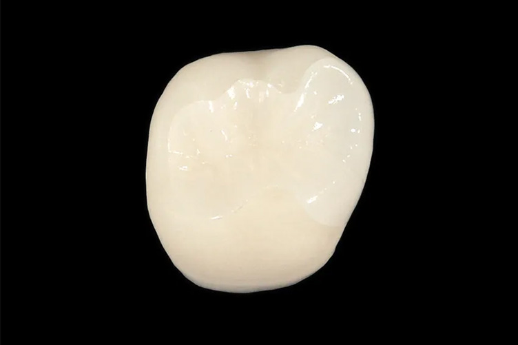 オールセラミック