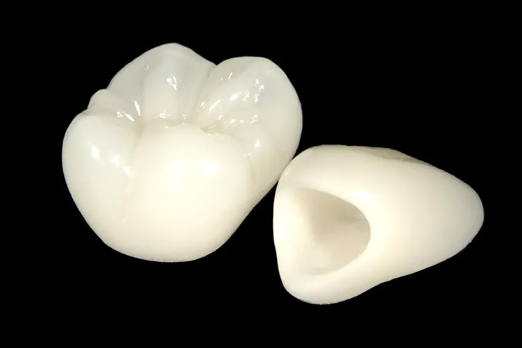 オールセラミック